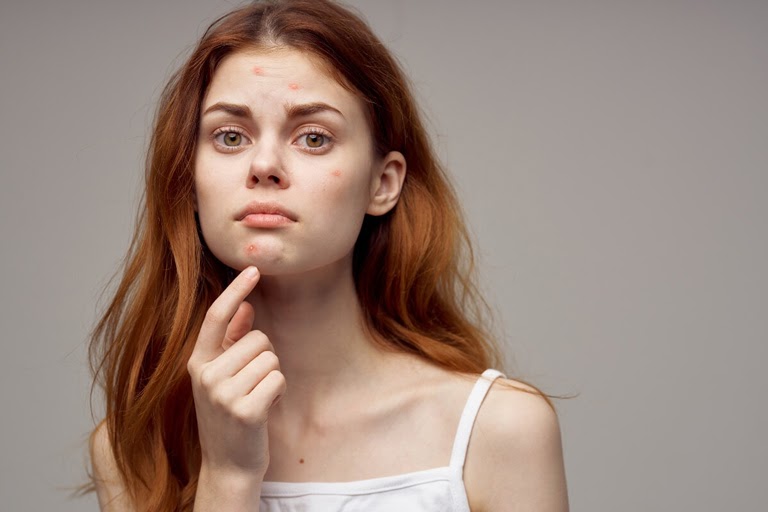 Tại sao các chủ đề về mụn luôn hot? (Nguồn: Internet)